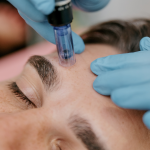 microneedling treatment, Microneedling: Your Key to Radiant Skin