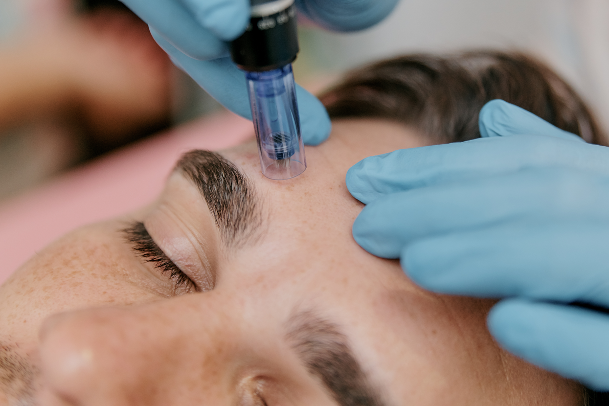 microneedling treatment, Microneedling: Your Key to Radiant Skin